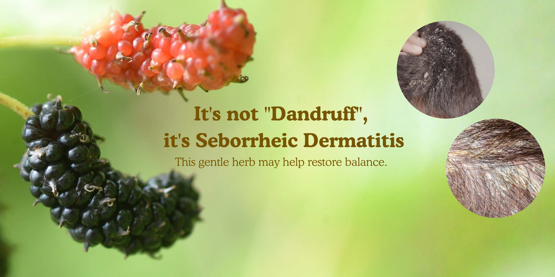 It's not "Dandruff", it's Seborrheic Dermatitis
